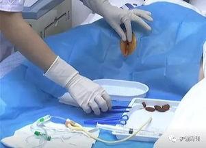 间导尿视频,间导尿操作步骤及注意事项详解